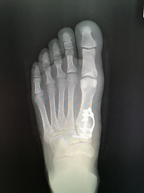 3D Bunion Correction | Ankle and Foot Medical Center
